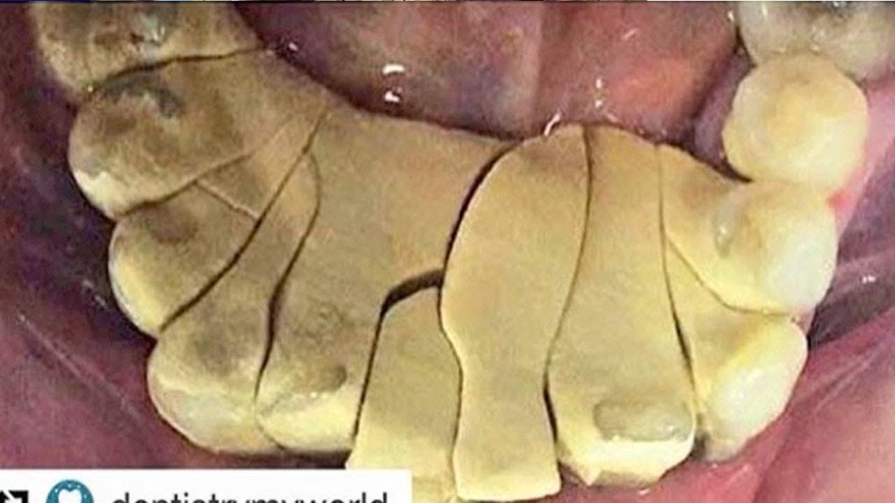 Worst Plaque! 2019's Thickest Tartar & Plaque