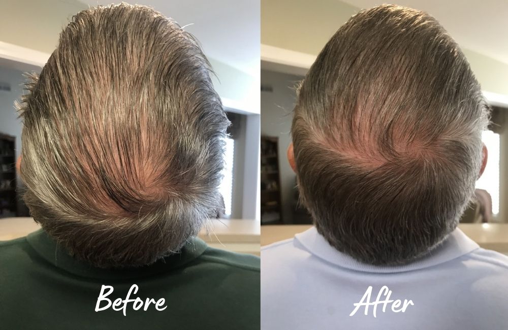 do laser caps work for hair loss - before and after